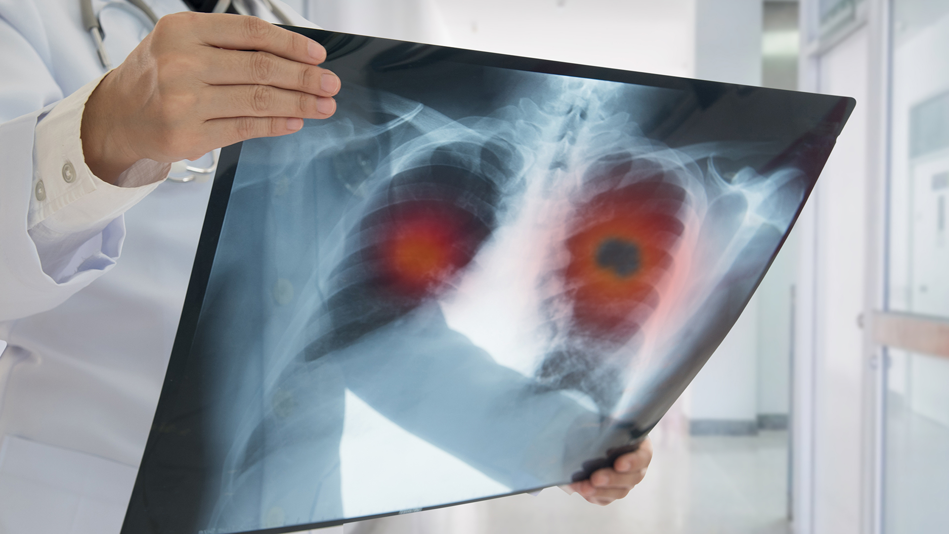 El cáncer de pulmón sigue siendo uno de los principales, tanto en incidencia como en muertes.