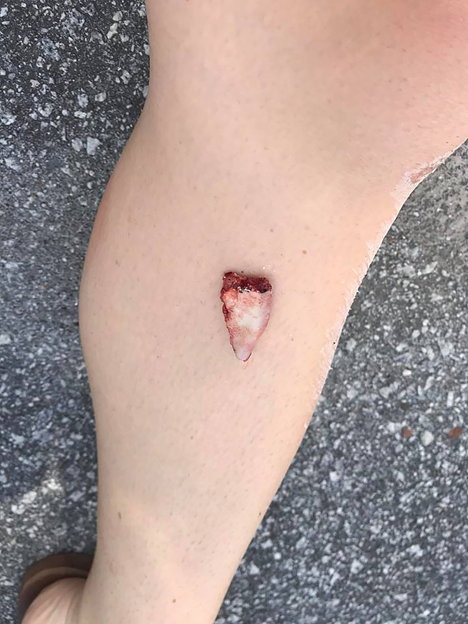 Kayla Hayes tenía sobre su pierna parte del labio amputado (@KaylaHayes)