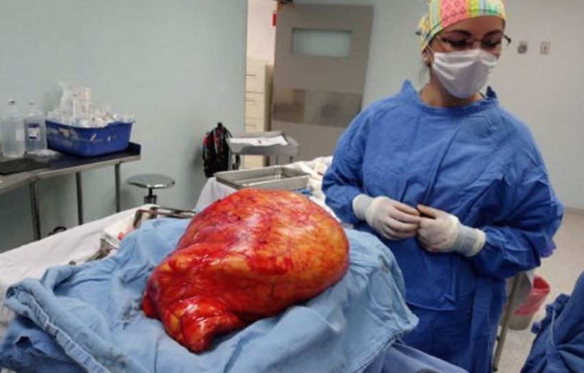 El tumor, de 17 kilogramos, se encontraba en una zona compleja que dificultaba la intervención (Foto: Tu_IMSS)