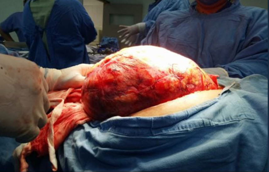 El equipo de oncólogos comprobó que el bazo y el riñón de la paciente estaban en riesgo de ser afectados por las células cancerígenas (Foto: Tu_IMSS)